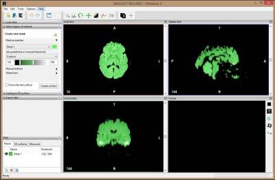 After loading the scans into Invesalius, you create the masks (in green)