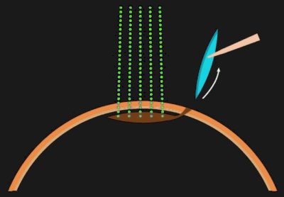 Femtosecond laser refractive surgery