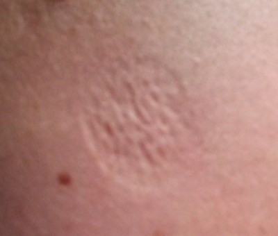This rather unappetising view is the scar on my arm from my smallpox vaccination.