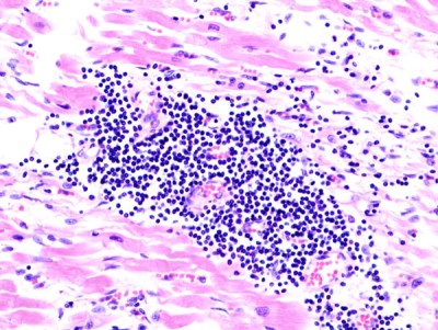 Viral myocarditis