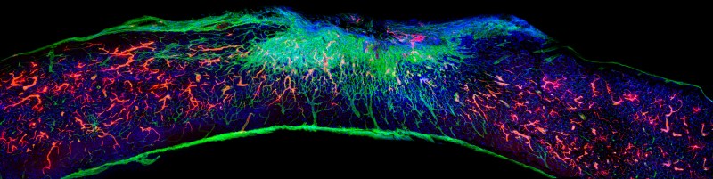 Longitudinal spinal cord section treated with the most bioactive therapeutic scaffold. Regenerated axons (red) regrew within the lesion. (Credit: Samuel I. Stupp Laboratory/Northwestern University)