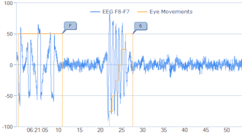 EEG graph with activity sections highlighted, one part highlighted as "F" and other as "6"
