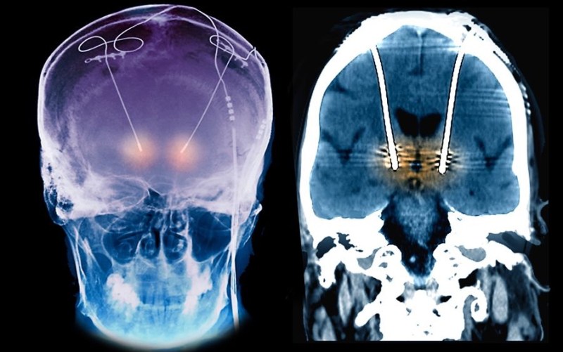 A scan (x-ray?) of a human skull. Electrodes trace around the skull and are attached to the brain. These implants are for reducing Parkinson's tremors.