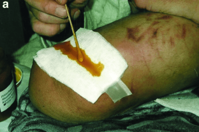 Revisiting Folk Wisdom For Modern Chronic Wound Care