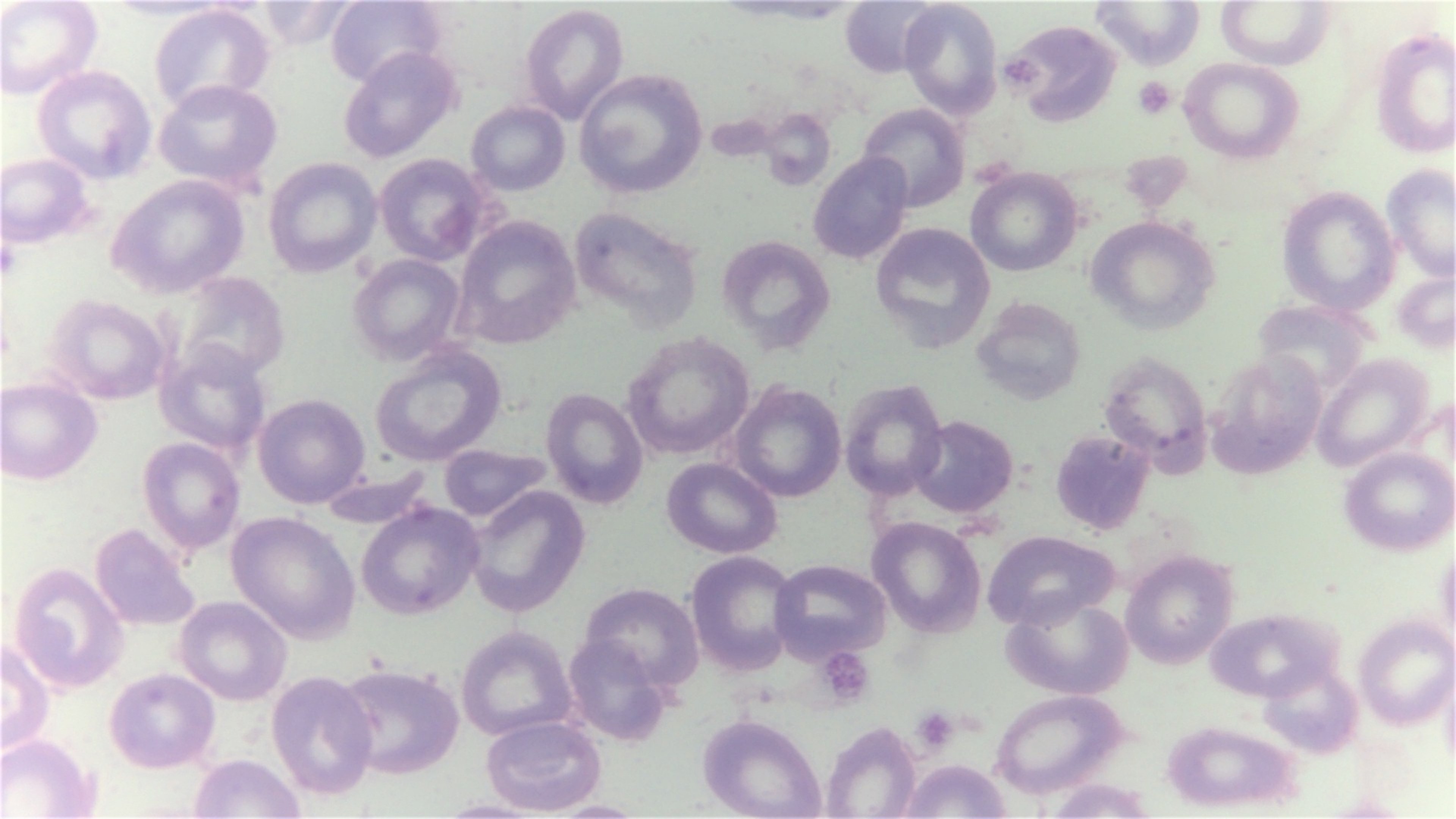 First CRISPR-Based Therapies For Sickle Cell Disease And Beta Thalassemia Approved In The UK