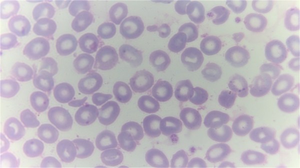 A giemsa stained blood smear from a person with beta thalassemia (Credit: Dr Graham Beards, Wikimedia Commons)
