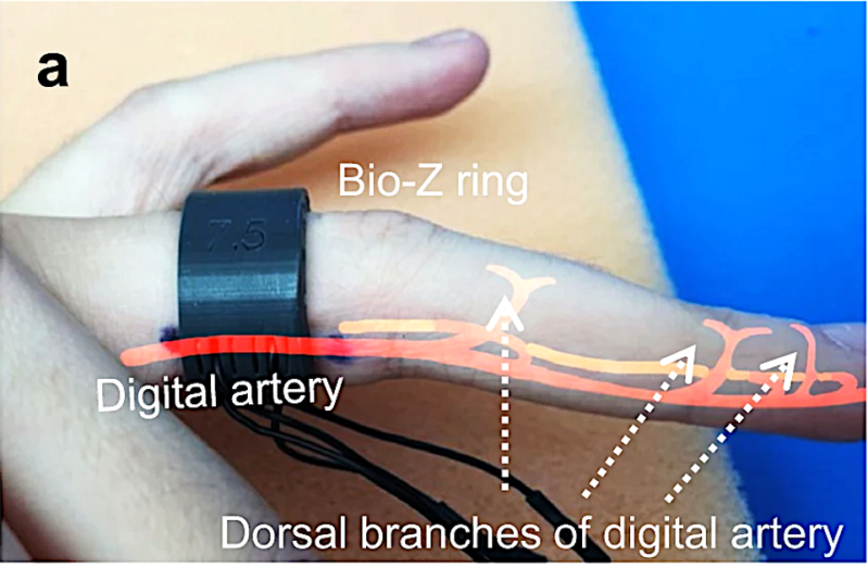 3D printed ring with 4-integrated electrodes for measuring bioimpedance for measuring blood pressure from the finger