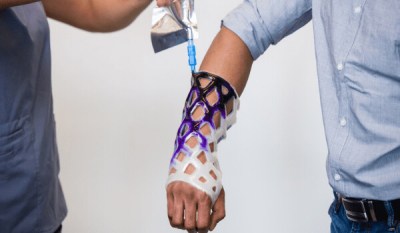 A medical professional fills a Cast21 with purple resin.