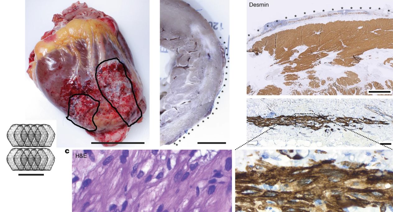 Patching Up Failing Hearts With Engineered Muscle Tissue